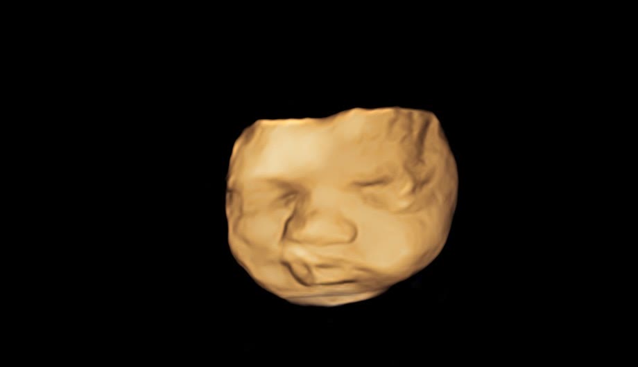 A warm, glowing 3D ultrasound render of a baby's sleeping face.