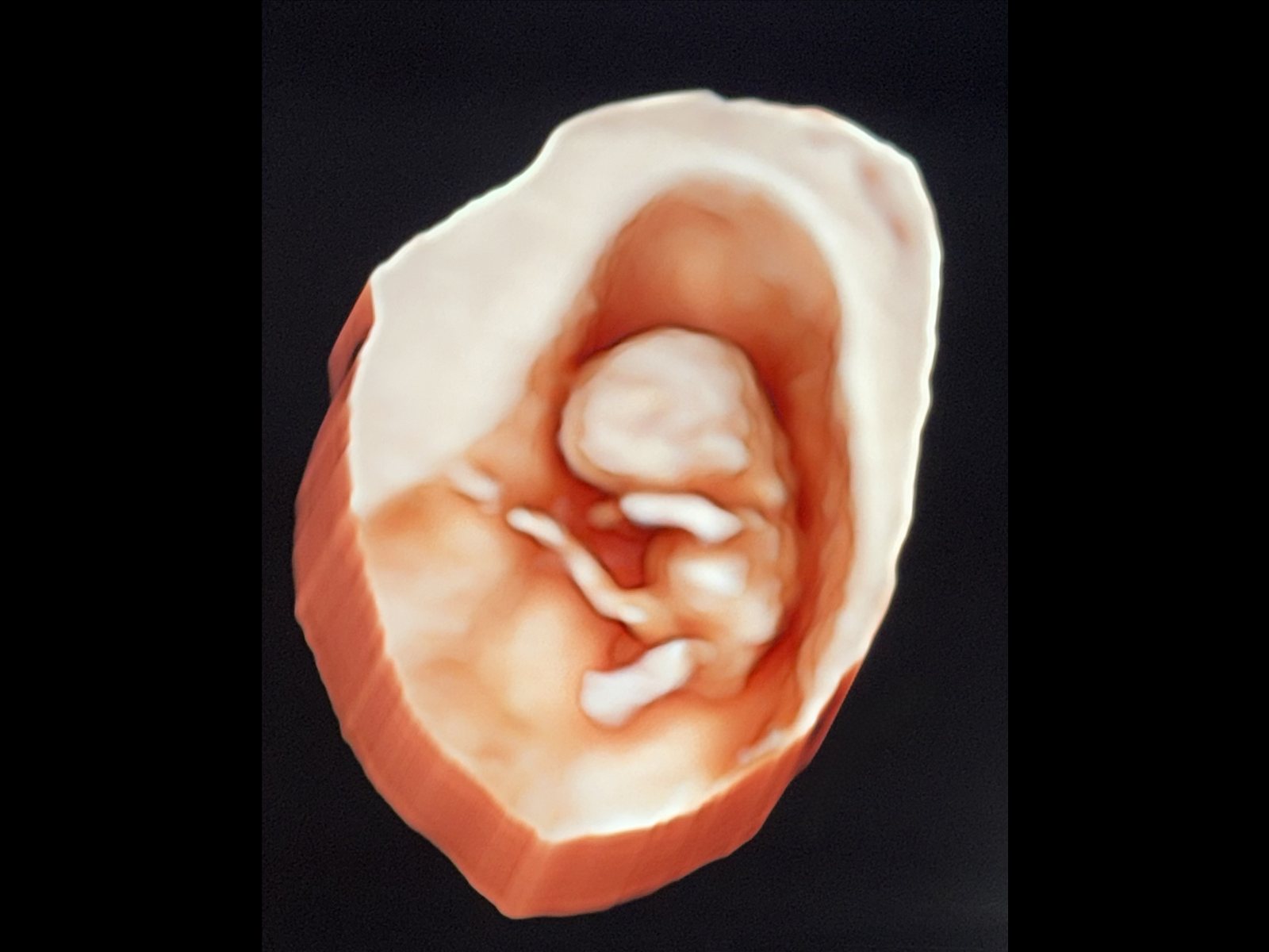 A warm 3D ultrasound render of a baby curled inside the womb.